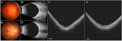 Investigation of Macular Structural and Microcirculatory Characteristics of Posterior Staphyloma in High Myopic Eyes by Swept Source Optical Coherence Tomography Angiography